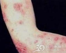 复发性线性棘层松解性皮肤病