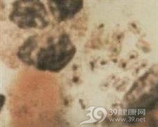 腹股沟肉芽肿