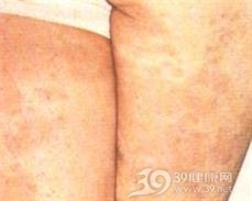 匐行穿孔性弹性组织变性