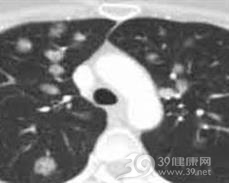肺假性淋巴瘤