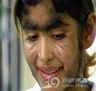 妇女多毛症