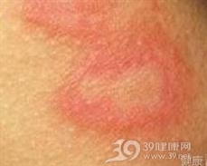 发疱性甲虫皮炎
