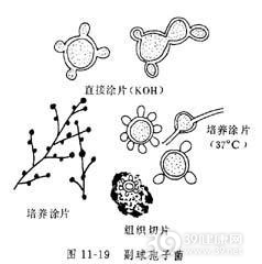 副球孢子菌病