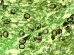 肺球孢子菌病