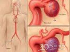 腹腔干动脉瘤