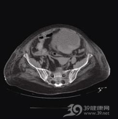 腹腔室隔综合征