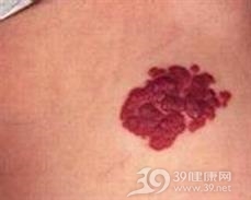 放射性皮炎
