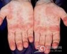 非特异性系统性坏死性小血管炎