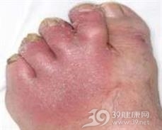 蜂窝织炎