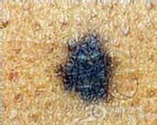 发育不良痣