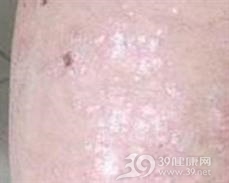 副银屑病