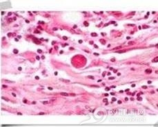 反应性穿孔性胶原病