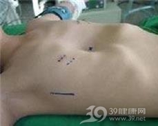 腹直肌鞘内血肿