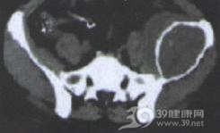 骨的恶性纤维组织细胞瘤