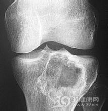 骨恶性纤维组织细胞瘤