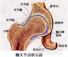 股骨头骨骺骨软骨病