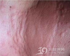钴及其化合物引起的皮肤病