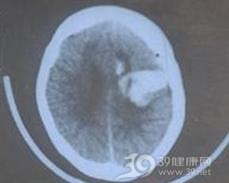 高颅压性脑积水