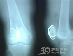 骨旁骨肉瘤