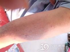 汞皮炎