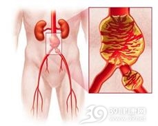 感染性腹主动脉瘤