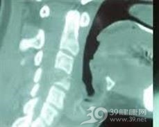 骨嗜酸性肉芽肿