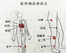 股外侧皮神经炎