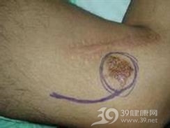 睾丸淋巴瘤