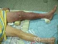 骨血管外皮细胞瘤
