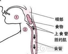 膈下食管憩室