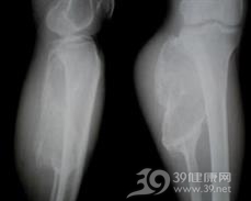 骨纤维肉瘤