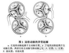 冠状动脉异常起源主动脉