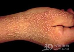 花斑癣