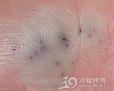 海胆刺伤及海胆肉芽肿
