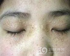 汗管棘皮瘤