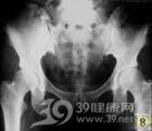 褐黄病性关节炎
