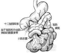 横结肠扭转