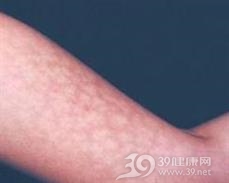 火激红斑