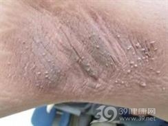 黑棘皮瘤