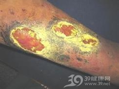 坏疽性脓皮病
