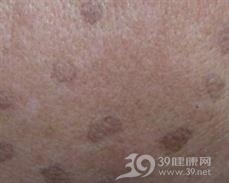 汗孔角化病