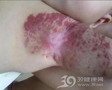 海绵状淋巴管瘤