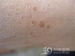灰泥角化病