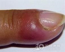 化脓性甲沟炎