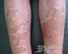 红皮病