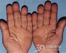 厚皮性骨膜病