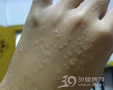 汗疱症