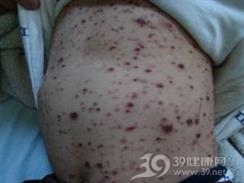 黑色丘疹性皮肤病