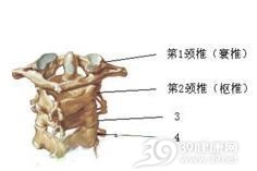寰枢椎旋转脱位固定