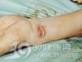 海鱼分枝杆菌感染